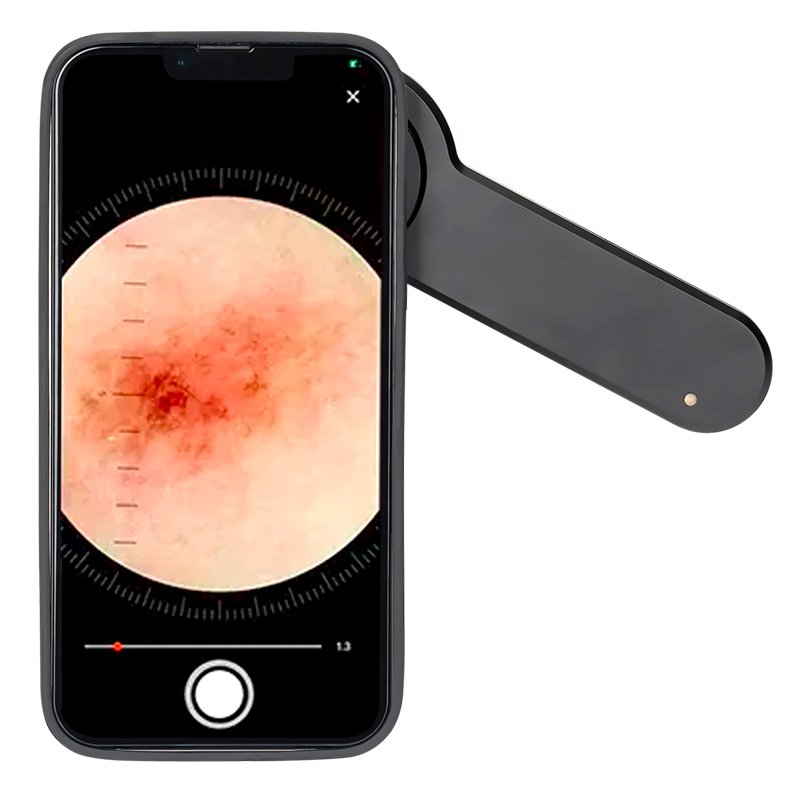 Mobile Phone Case For Dermatoscope