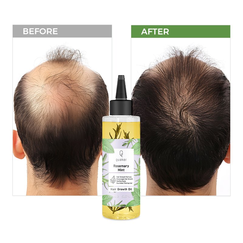 Qquaker Aceite Para El Crecimiento Del Cabello Hair Essential Oil Rosemary Oil Hair Growth Hair Growth Oil