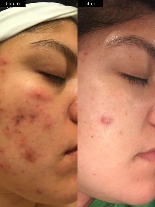 Bha Anti Acne Removal Cremas Para El Acne Face Skin Care Cleanser Serum Cream Kit Salicylic Acid Acne Treatment Skin Care Set