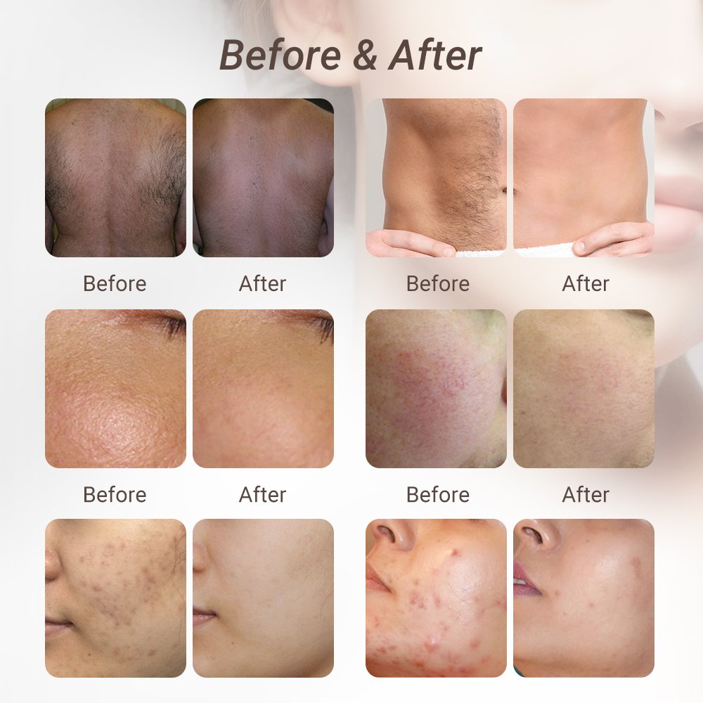 Winkonlaser Intense Pulsed Light Portable DPL NIR Machine OPT E-Light Skin Rejuvenation IPL Laser Hair Removal
