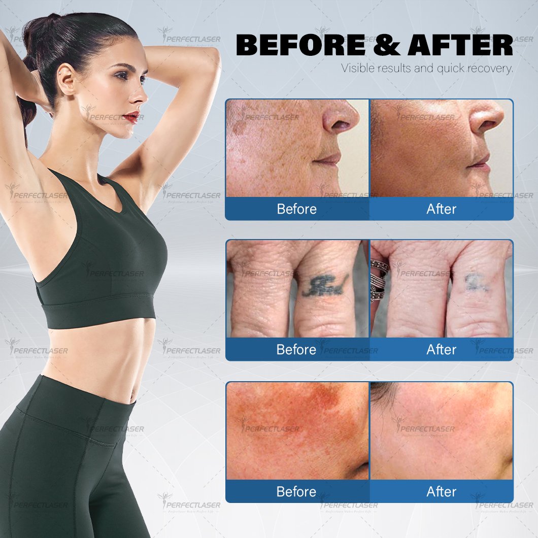 Perfectlaser 2024 Best nd yag Laser Picosecond Tattoo Removal Machine Price 4 Wavelengths Portable Q Switched Pico Laser Machine