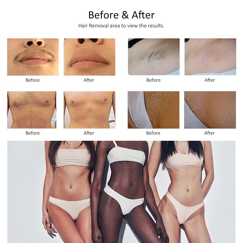 Medical CE CFDA 2 Handles 1600w 2000w 4 Wavelength 808Nm Diode Laser Hair Removal Machine Price