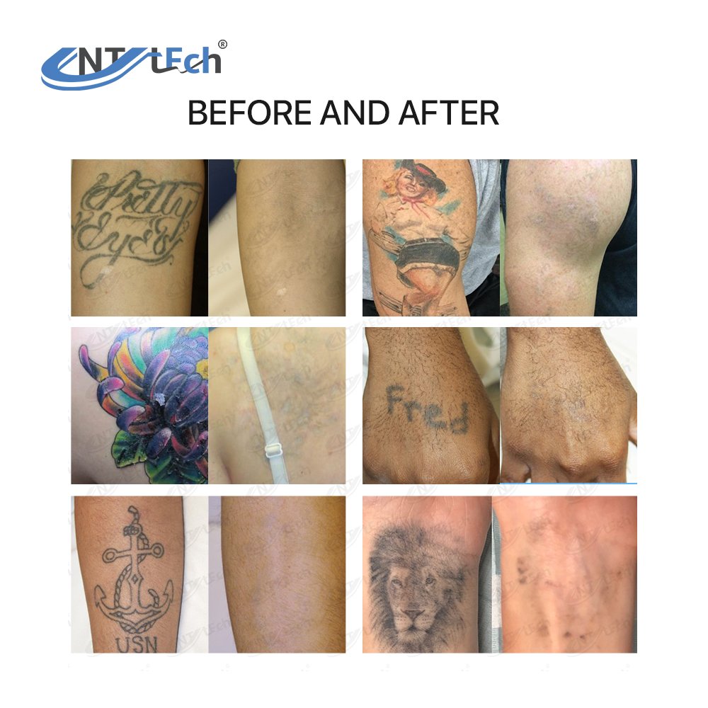 New professional nd yag laser picosecond laser q switched tattoo removal machine