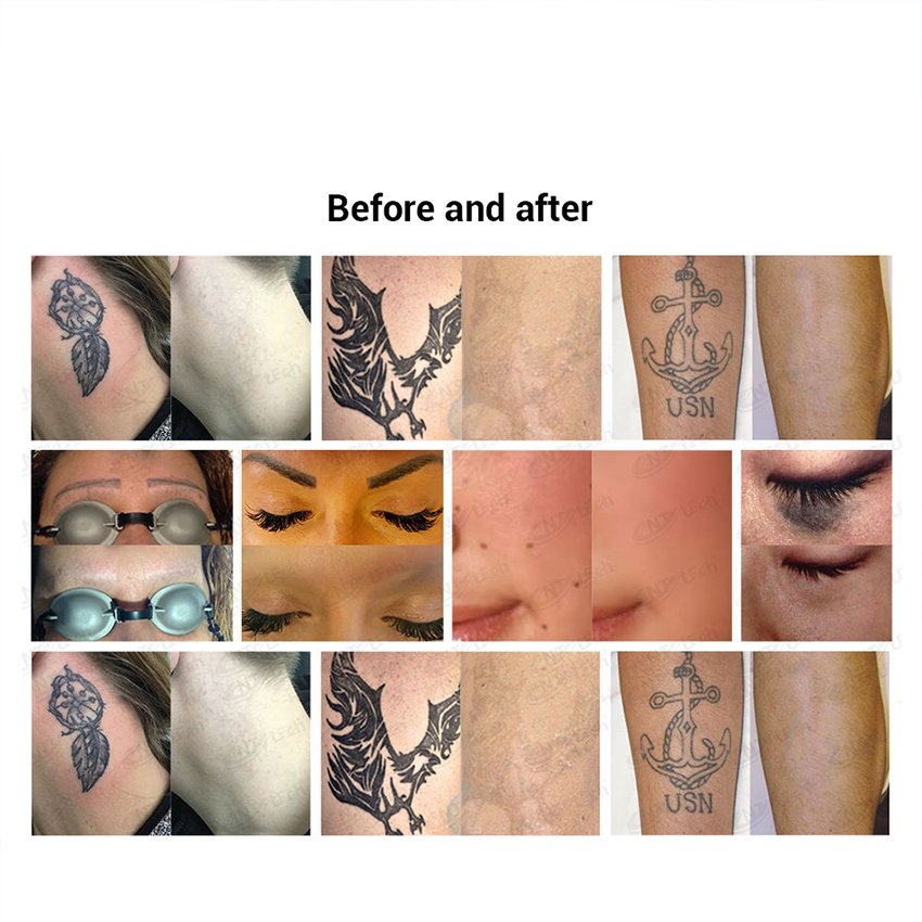 Nd Yag Laser Machine Spare Parts Adjustable Spot Size Tattoo Handle Probe 532nm 1064nm For Maintenance