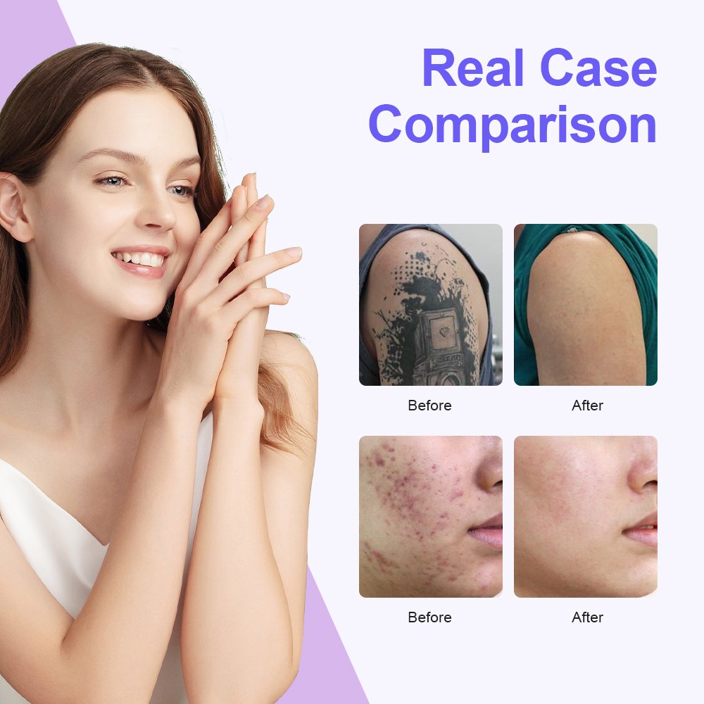 Pico laser tattoo removal machine 532 1064 755nm for skin picosecond laser Switch Nd Yag Pico Laser Tattoo Removal Machine