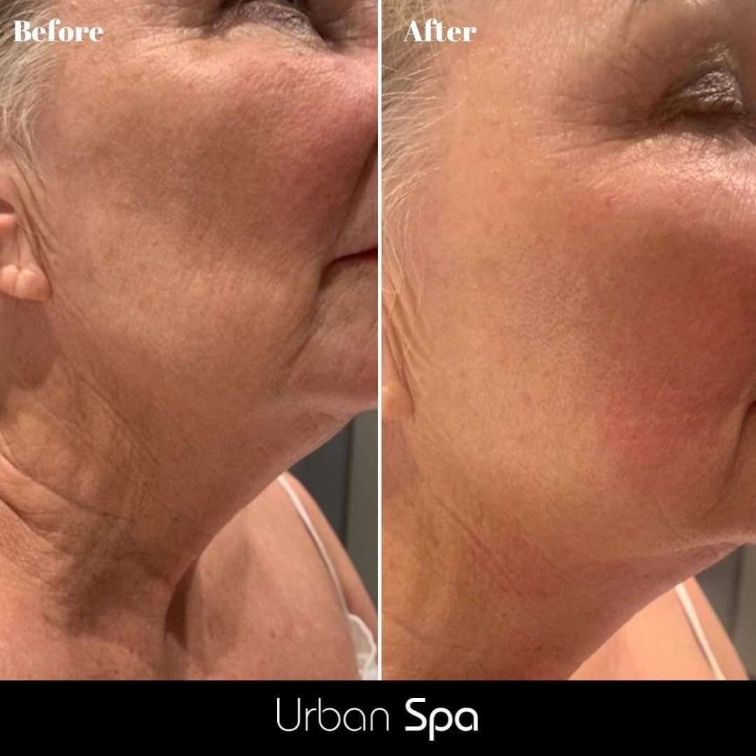 Monaliza-10 Q Switched Nd YAG Laser All Tattoo Inks Removal Carbon Facial Peel Skin Rejuvenation Hyperpigmentation Reduction