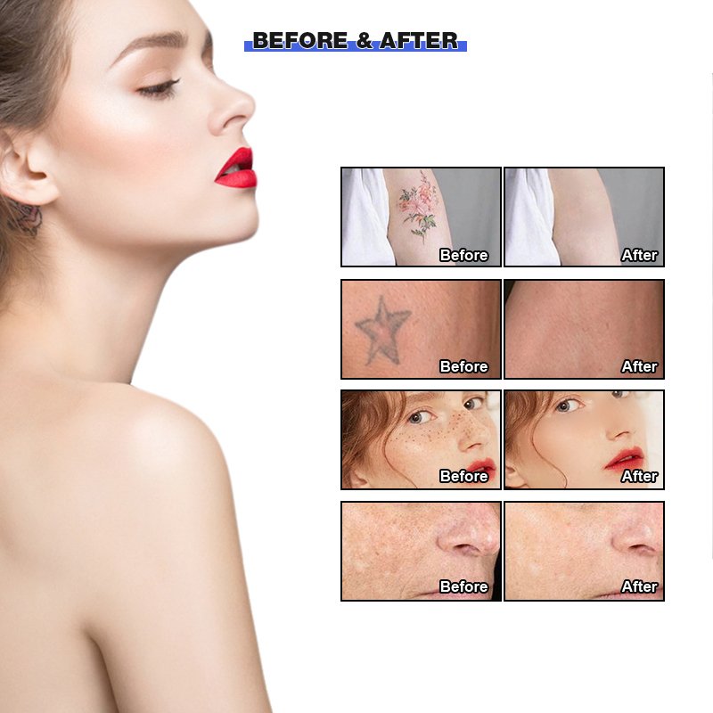 CE Certification Nd Yag Laser Picosecond Laser Tattoo Removal Machine Price Tattoo Removal Machine Laser Tattoo Removal Machine