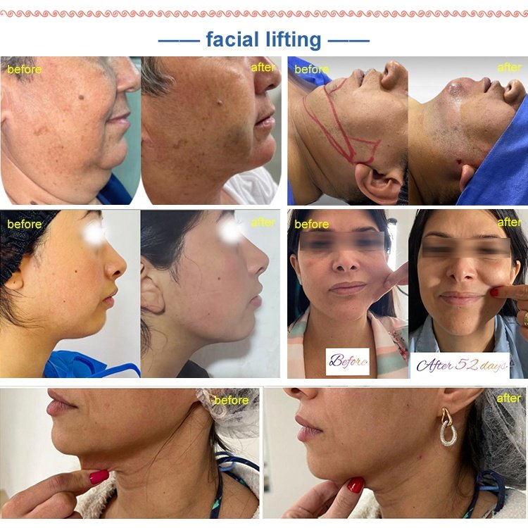 2023 newest diode lipo laser machine 980nm 1470nm diode laser liposuction /lipolisis slimming endolaser machine