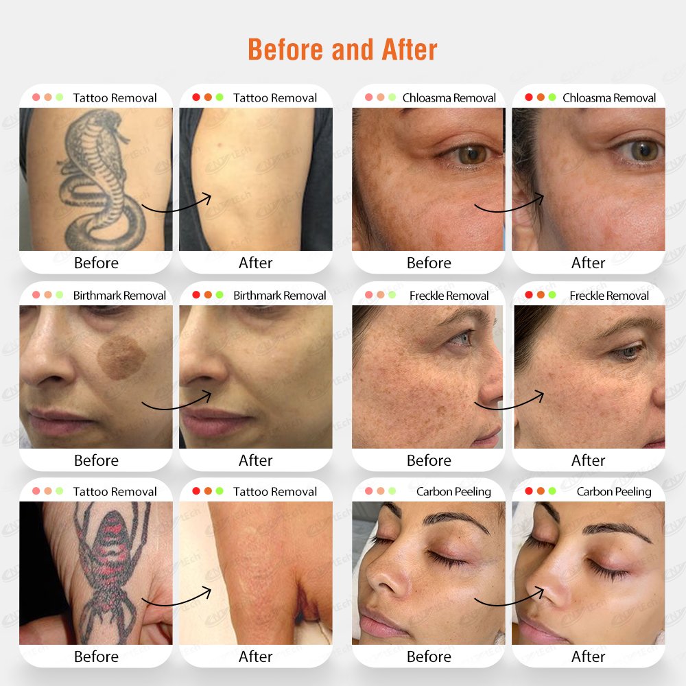 Excellent treatment results laser picosecond tattoo removal machine