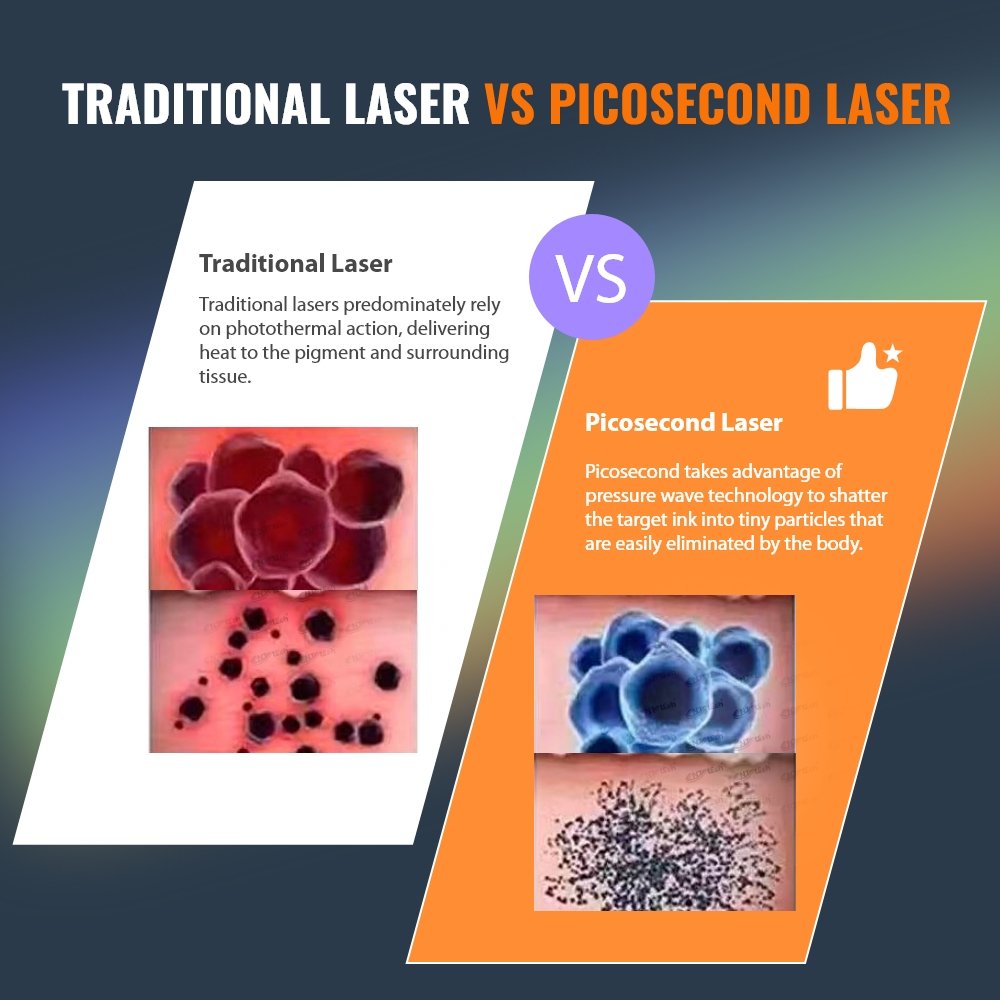 Excellent treatment results laser picosecond tattoo removal machine