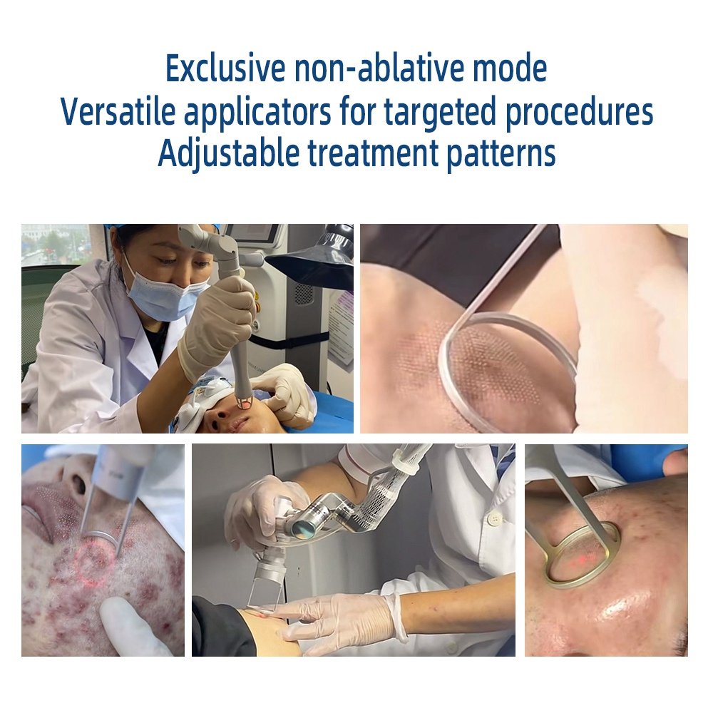 Seek Agents! Glass/RF Tube 70W Fractional vaginal co2 laser Tightening Beauty Equipment Sale Portable Co2 fractional co2 laser