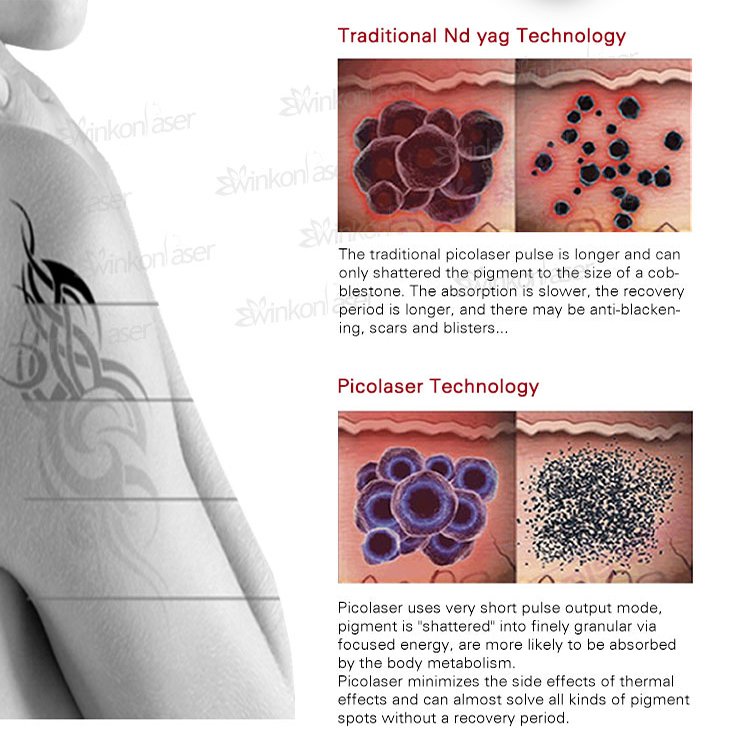 Winkonlaser Professional Pico Q-Switched Nd Yag Laser 1064Nm 532Nm Pico Carbon Peeling Tattoo Removal Machine