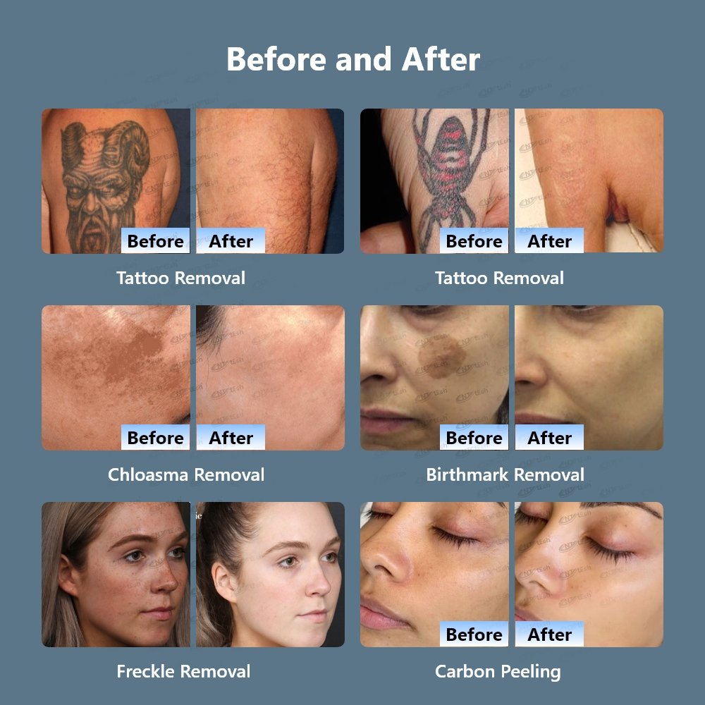 Hot sale best selling q switched laser removal tattoo machine