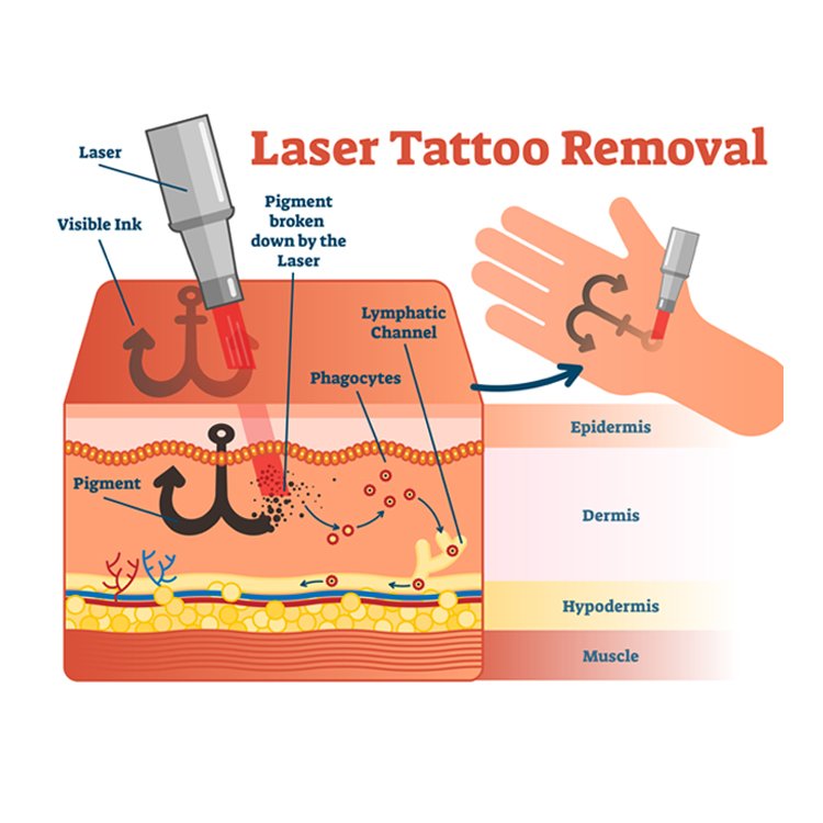 ndyag q-switch laser tattoo removal laser tattoo removal machine laser hair removal and tattoo machine