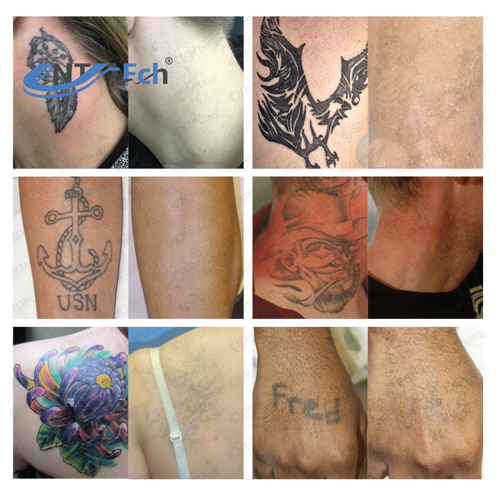 UNT portable professional carbon peel q switched nd yag laser tattoo removal machine