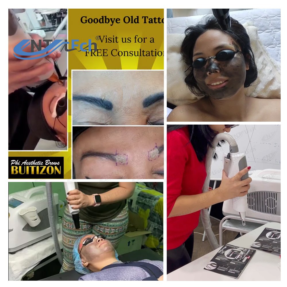 UNT portable professional carbon peel q switched nd yag laser tattoo removal machine