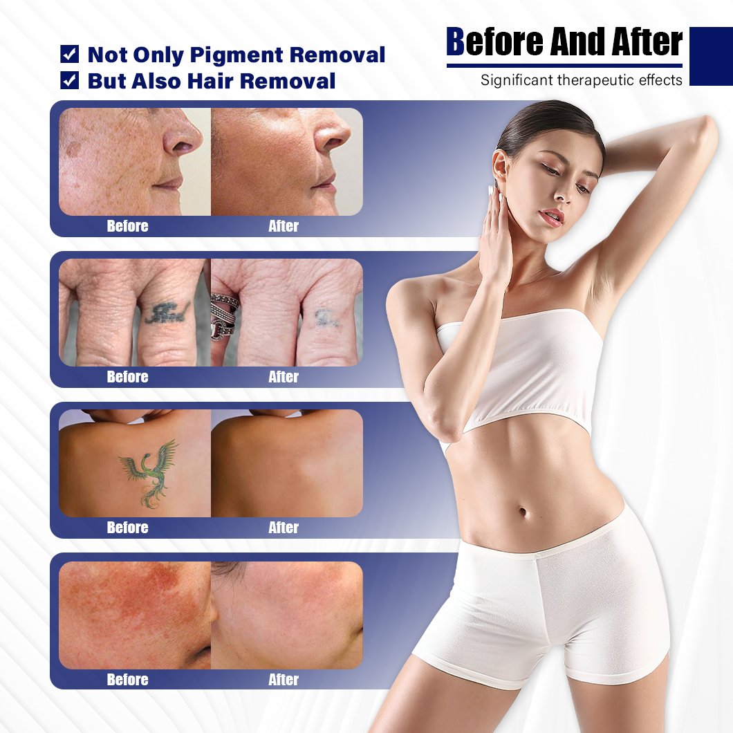 CE Rohs Approve 532 755 1064 1320nm pico laser 2024 Best q Switched Picosecond Tattoo Removal Machine Price
