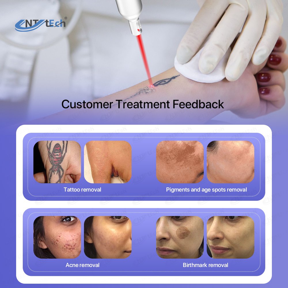 Best effect portable Nd Yag Laser laser tattoo removal machine for sale