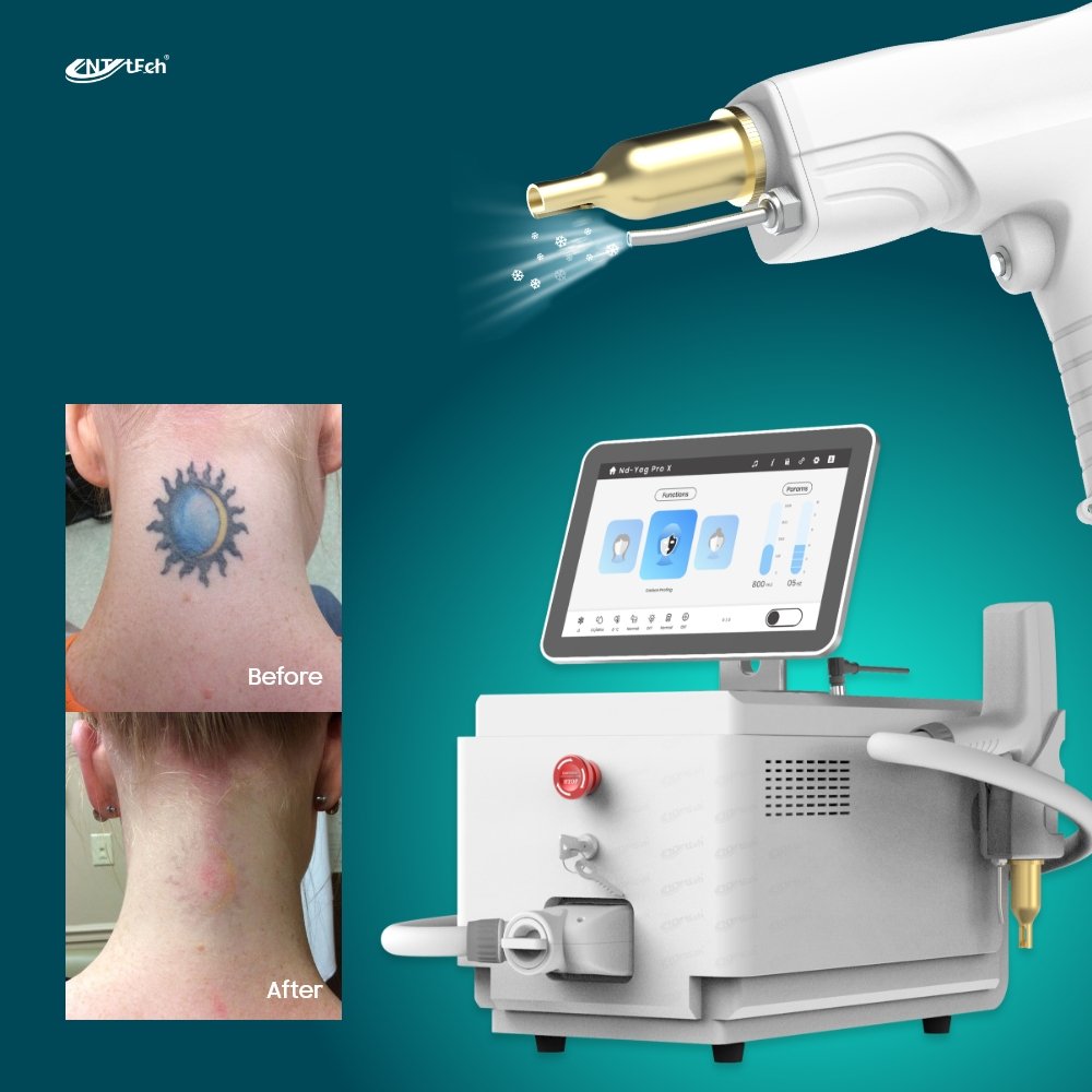 Q switched nd yag picosecond laser portable nd yag laser tattoo removal machine
