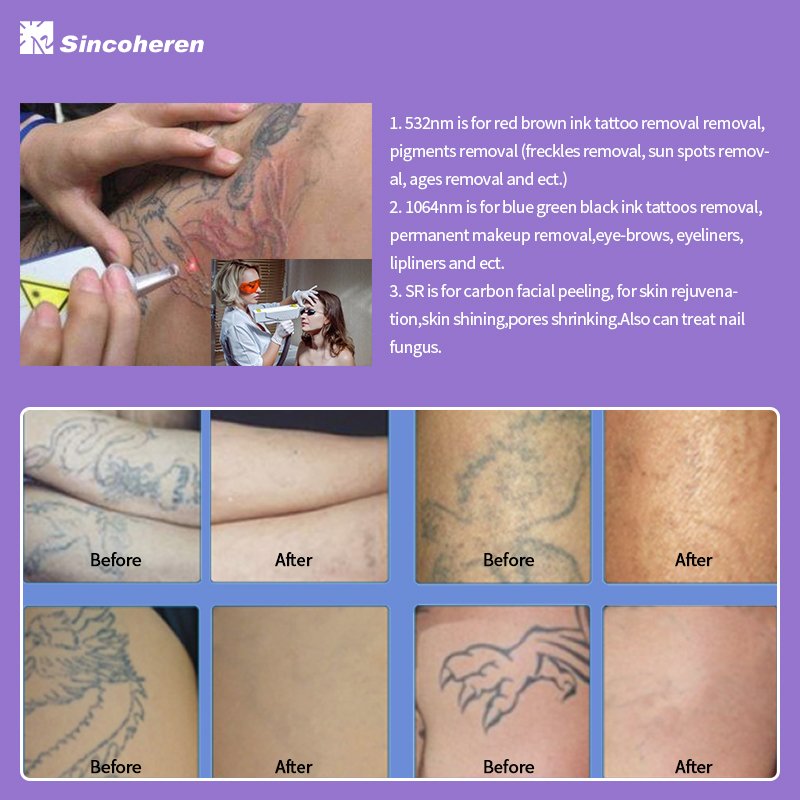2023 Sincoheren Professional Q Switched Nd yag 1064nm 532nm Picosecond Laser Tattoo Removal Machine