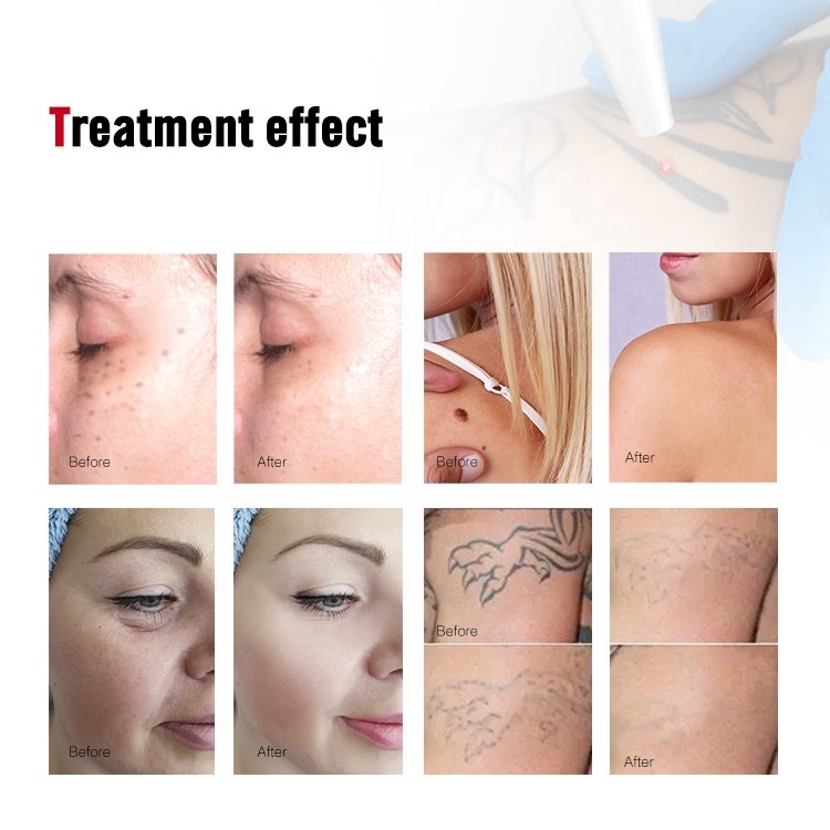 TUV CE approved q switched nd yag laser tattoo removal Carbon Peeling Eyebrow Pigment Pico laser machine