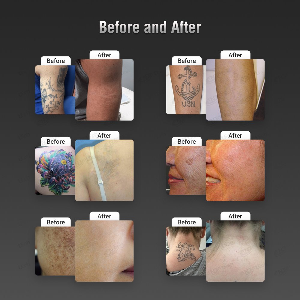 portable nd yag laser q switched tattoo removal carbon laser peel machine