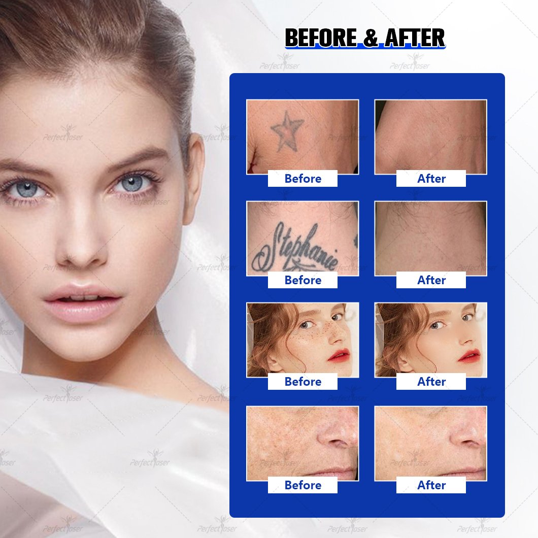 Portable Professional Q Switch Pico Laser Tattoo Removal Machine 2024 New 532nm 755nm 1064nm 1320nm Picosecond laser price