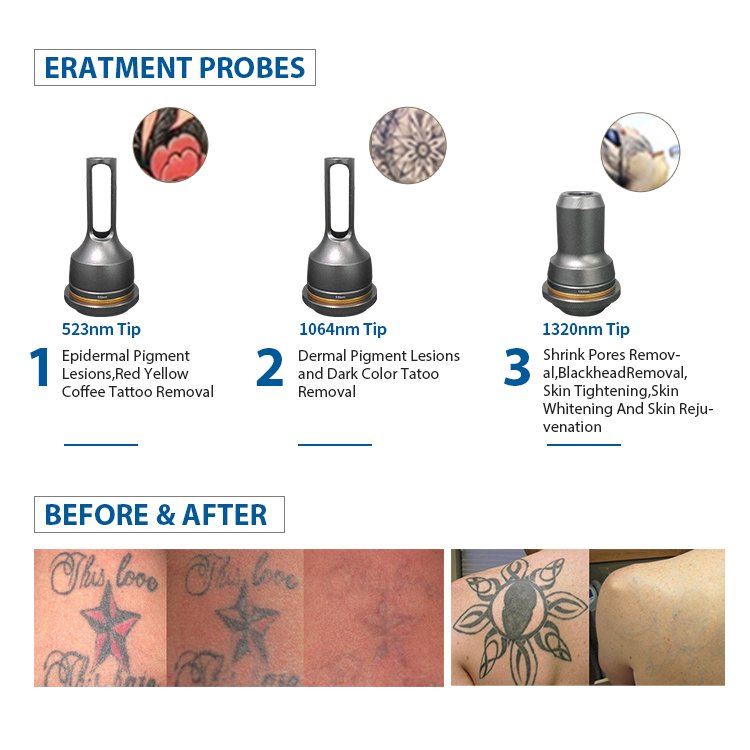 Q-Switched Tattoo Removal Picosecond Laser Machine tatoo remover laser