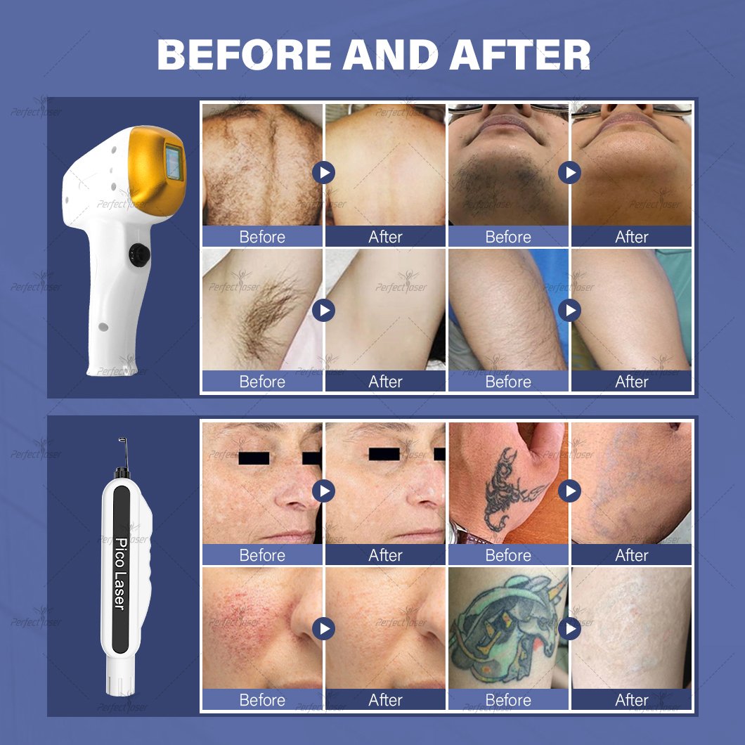 Perfectlaser Multifunctional nd yag Pico Laser Price 2024 New Portable Ice 755nm 1064nm 808 nm Diode Laser Hair Removal Machine