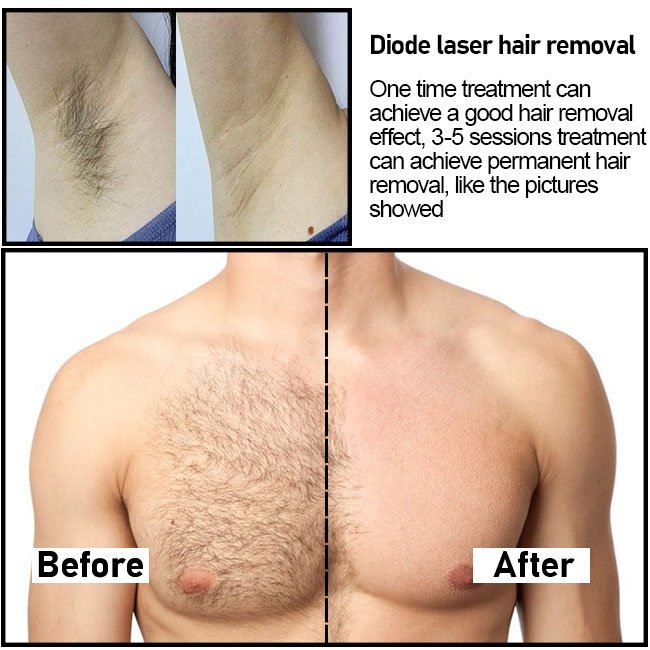 Diode Laser Varicose Veins Laser Treatment Machine of Good Quality Hair Removal Machine Medical CE TUV Approved 980nm Stationary