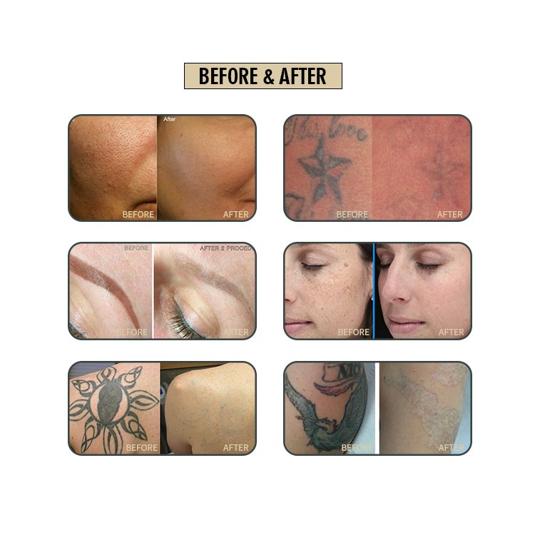 professional portable mini nd yag laser tattoo removal machine hair removal device