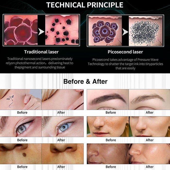 Laser beauty 2in1 ICE Diode Laser 755 808 1064 hair removal machine picosecond pico laser q-switched nd yag tttoo removal