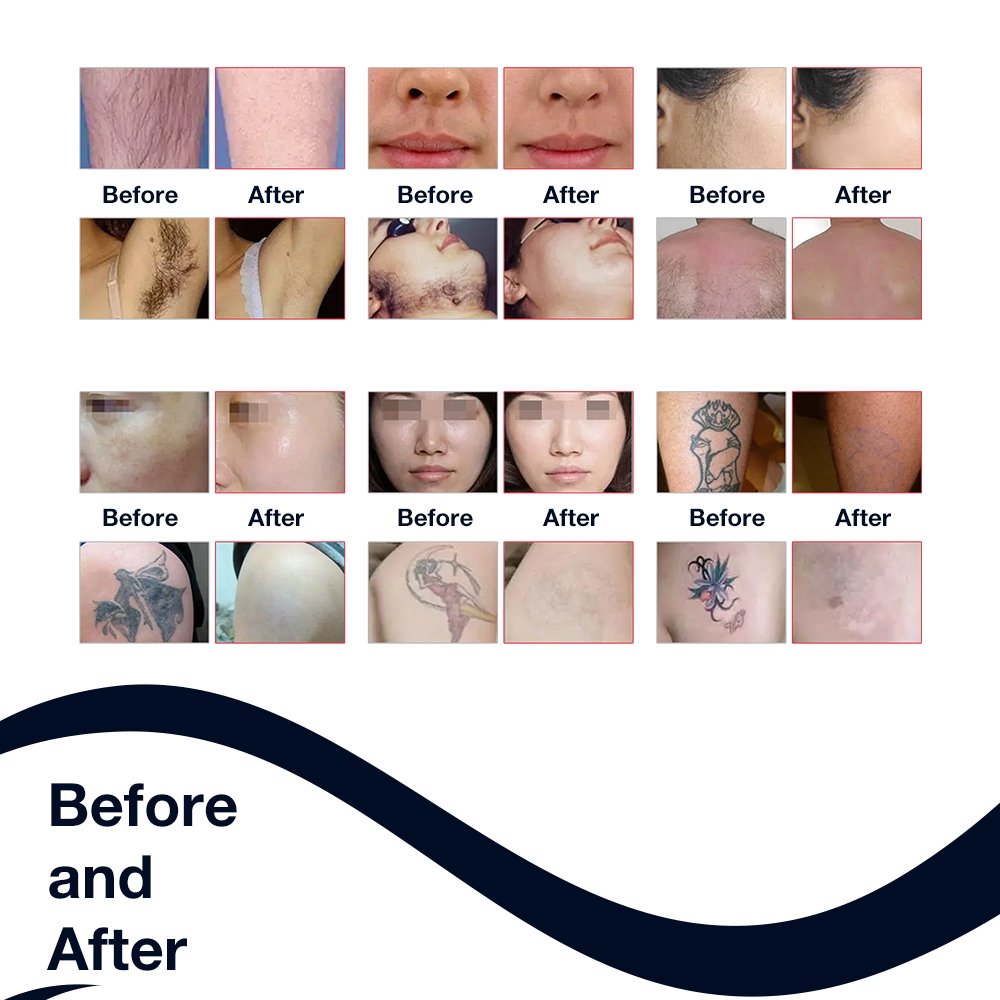 Ice Titanium 4 Waves 755 808 980 1064 Diode Laser Hair Removal And 2In1 Nd Yag Laser Tattoo Removal Machine