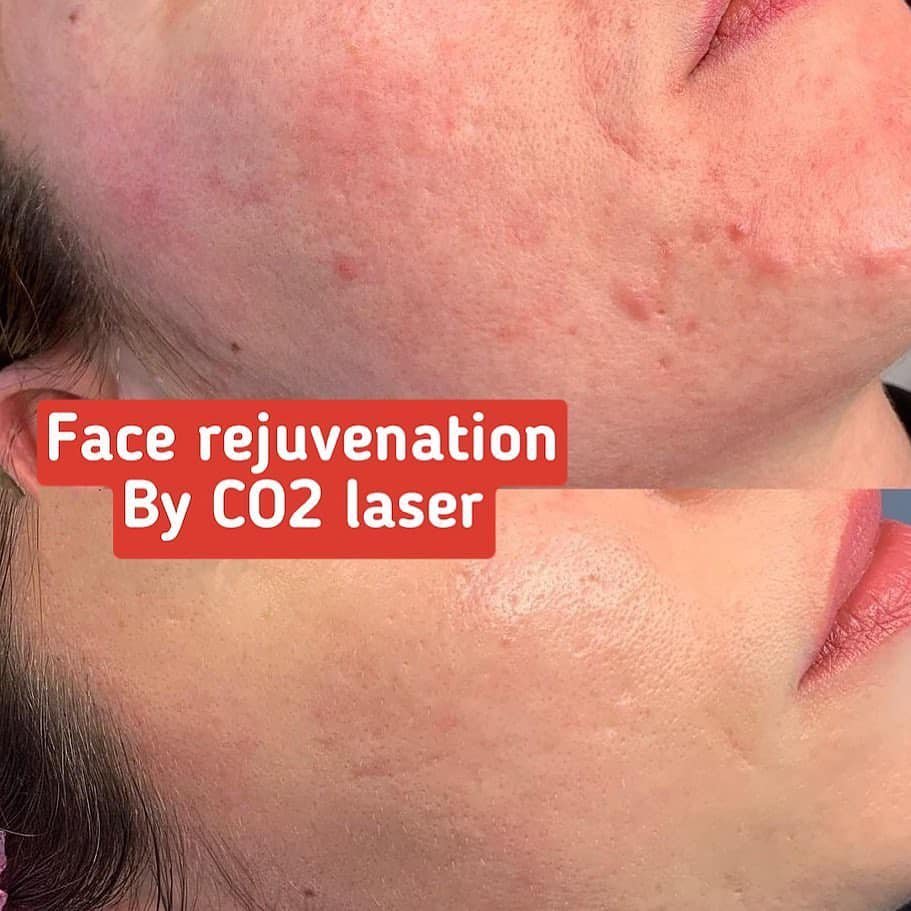 Factory supply new update co2 fractional laser machine for facial rejuvenation wrinkle removal vaginal resurfacing