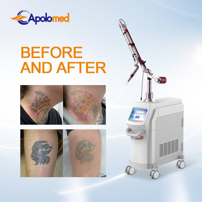 Apolomed Medical CE Q Switch pico laser Tattoo Remover ND YAG Laser Device