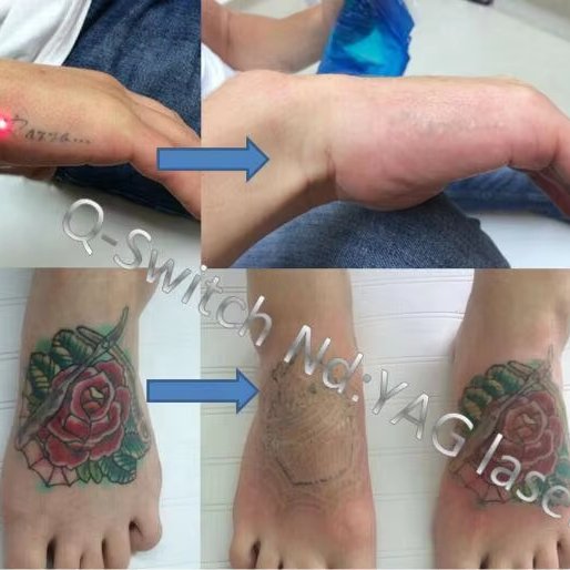 2024 755nm nd yag q-switched laser picosecond laser tattoo pigment acne scar removal pico laser machine for tattoo remove