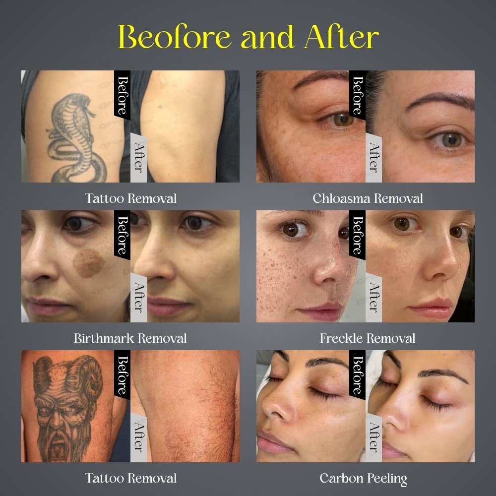 Multifunctional pico laser tattoo removal picosecond laser machine