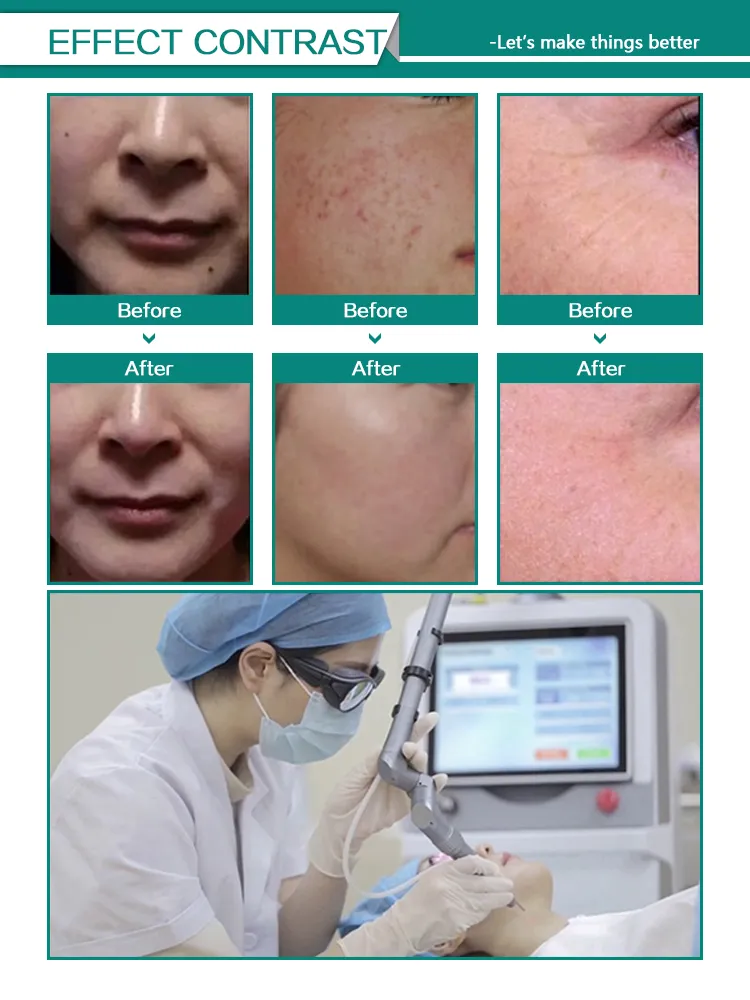 Factory Price Co2 Laser Machine Tattoo Removal Machine Skin Rejuvenation Machine