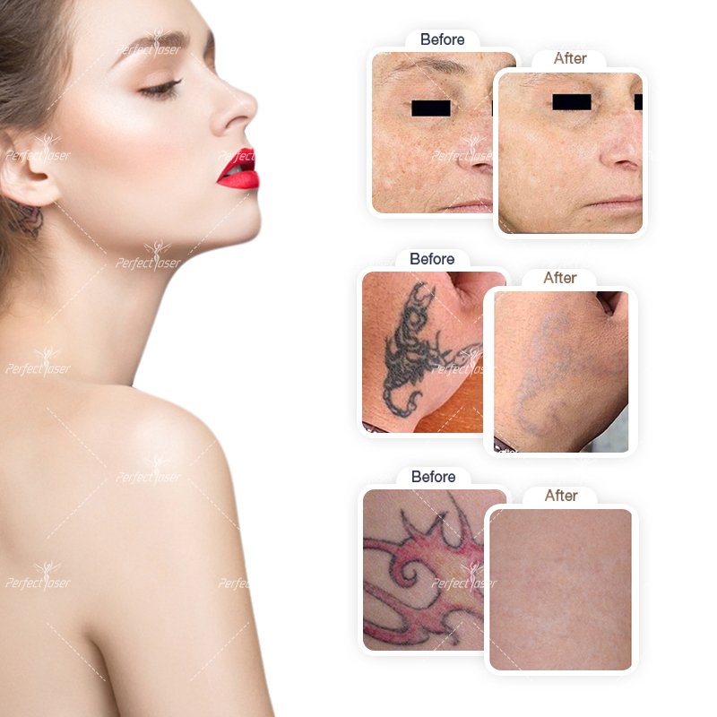 Picosecond 1064 Nm 755nm 532nm Pico Q Switched Nd Yag Laser Pico Laser Tattoo Removal Machine Price Picosecond Laser Machine