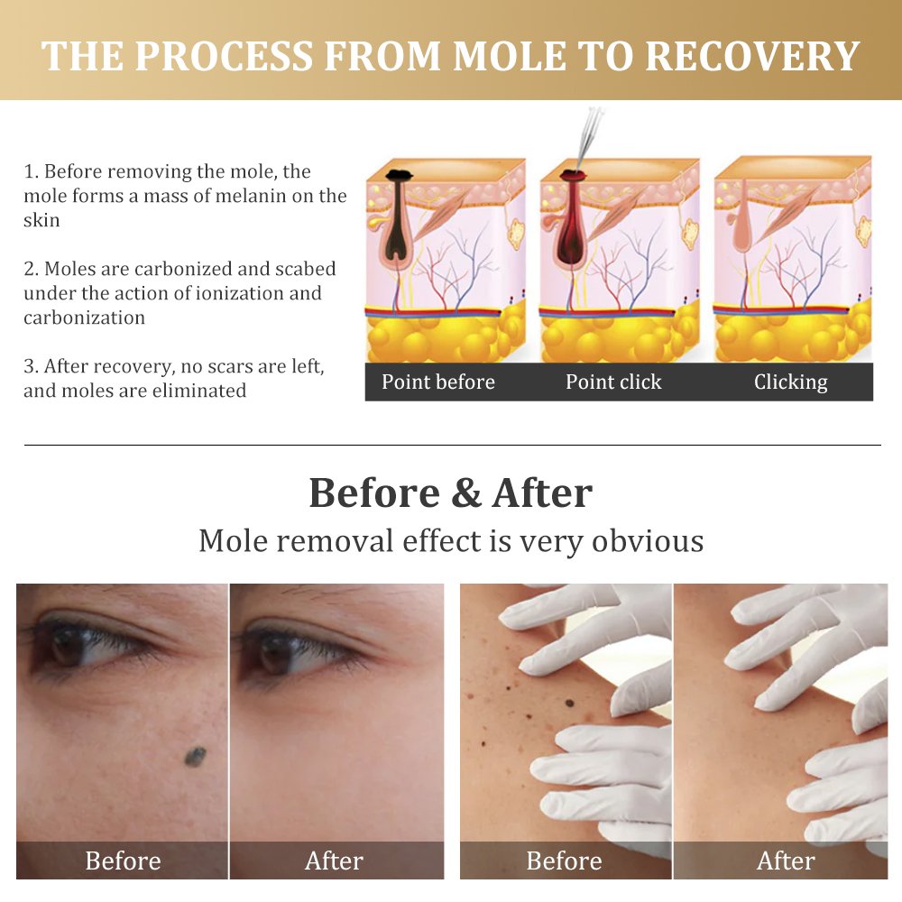 Trends Plasma pen Facial Tag Removal painless Plasma Pen Cauterizer Removing Electrocautery Wart Papilloma Skin Eraser Mole Pen