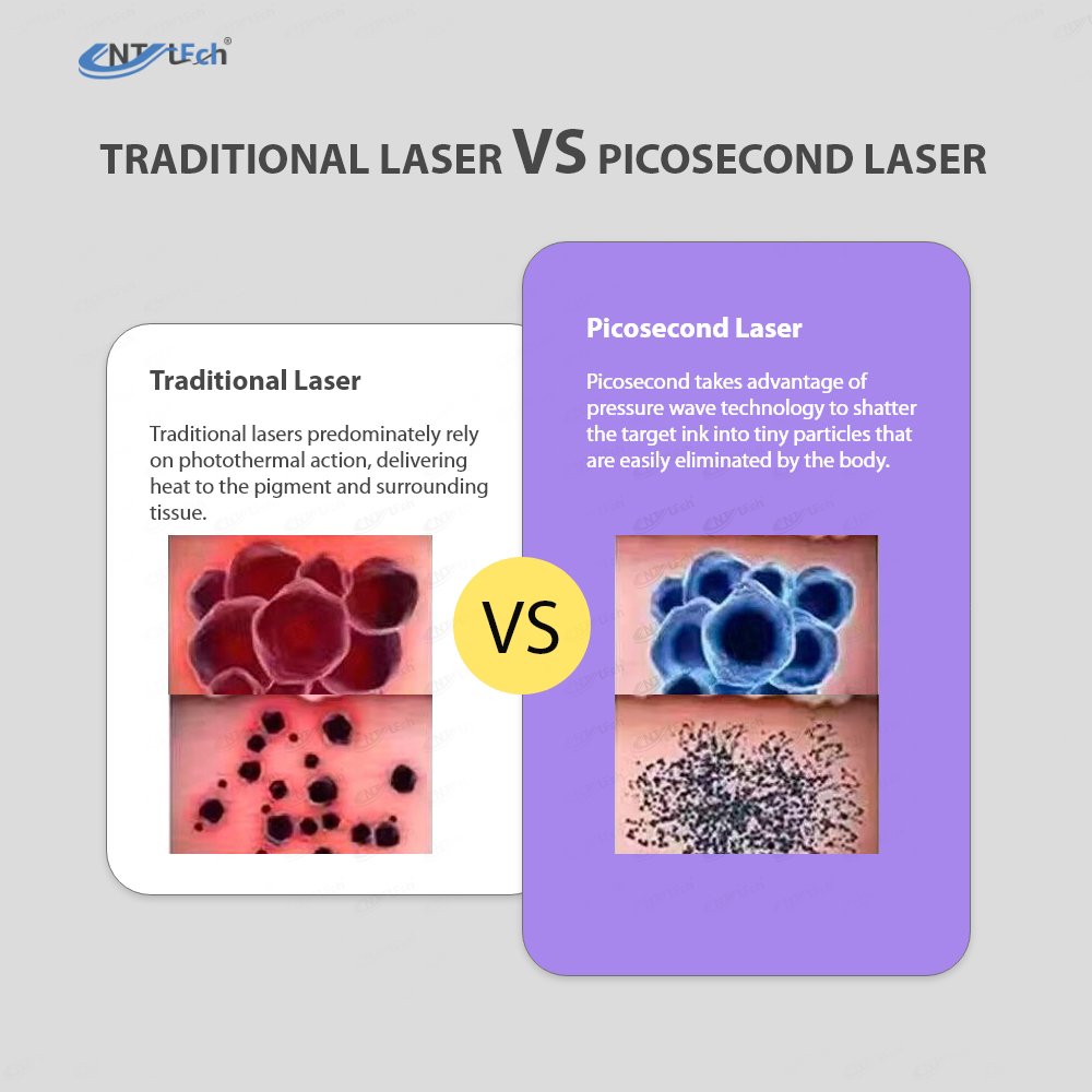 Beijing UNT fast delivery picosecond machine 1064 laser q-switched system nd yag laser picolaser tattoo removal