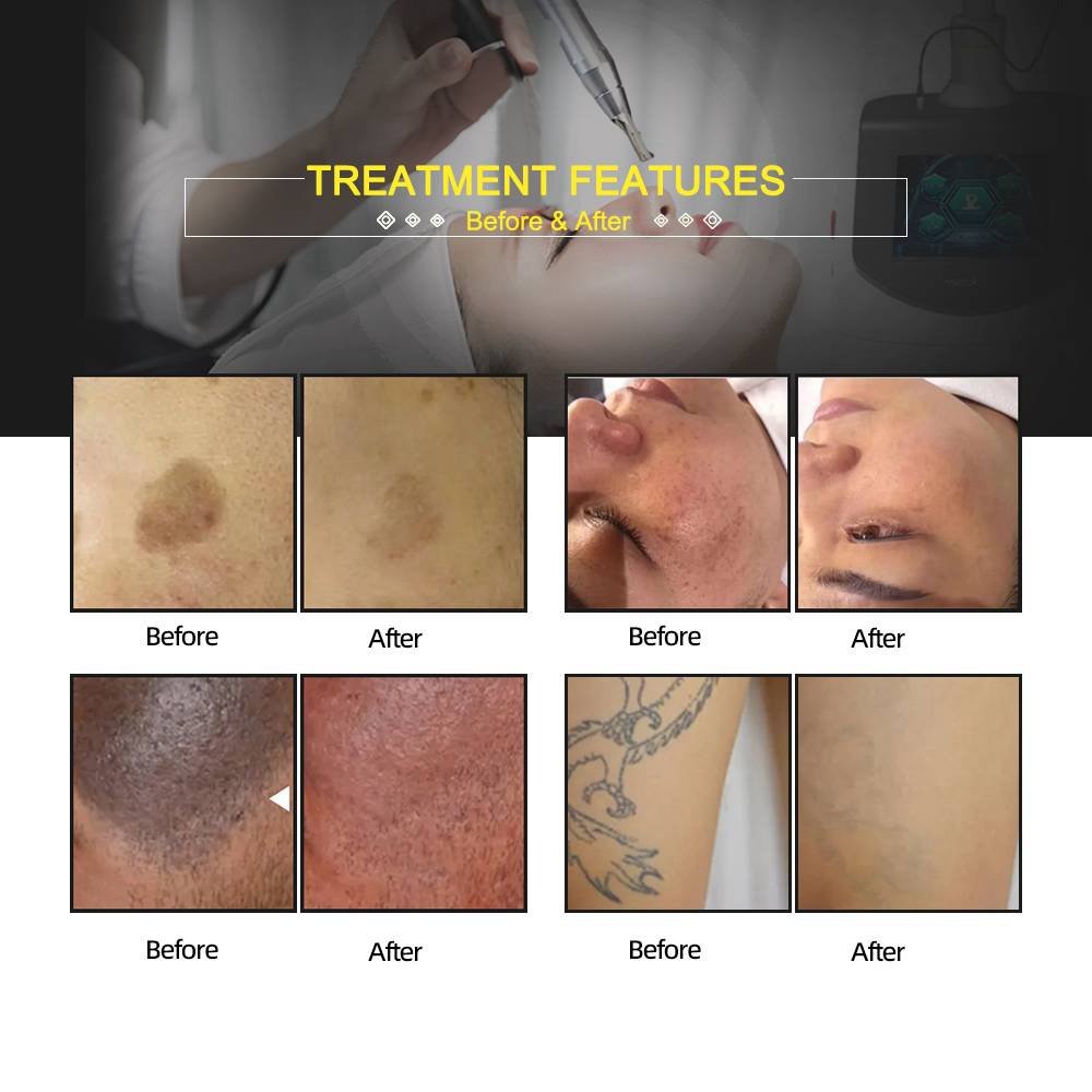 Professional Laser tattoo Cleaning Machine Korea Nd Yag Picosecond Laser Machine Msalon Equipment Sets tattoo Removal Laser