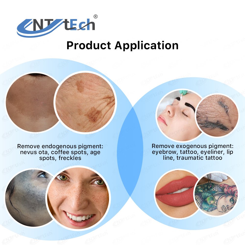 Mini qswitch nd yag laser tattoo removal pico second laser carbon peeling machine