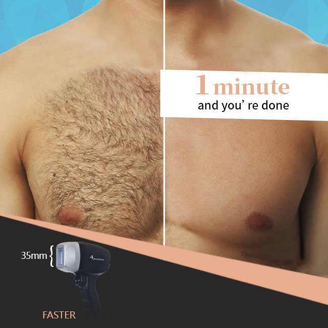 Titanium diode laser hair removal treatment laser 755 808 1064 germany bar for hair removal