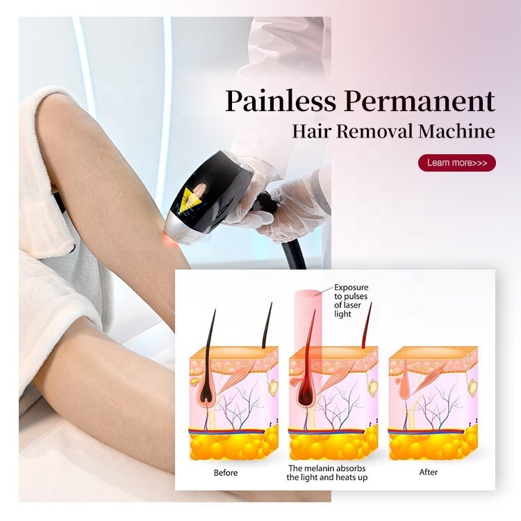 Alexandrite Laser Epilator Ice Platinum Diode Laser 755 808 1064 Deka Laser Alexandrite Permanent Hair Remover
