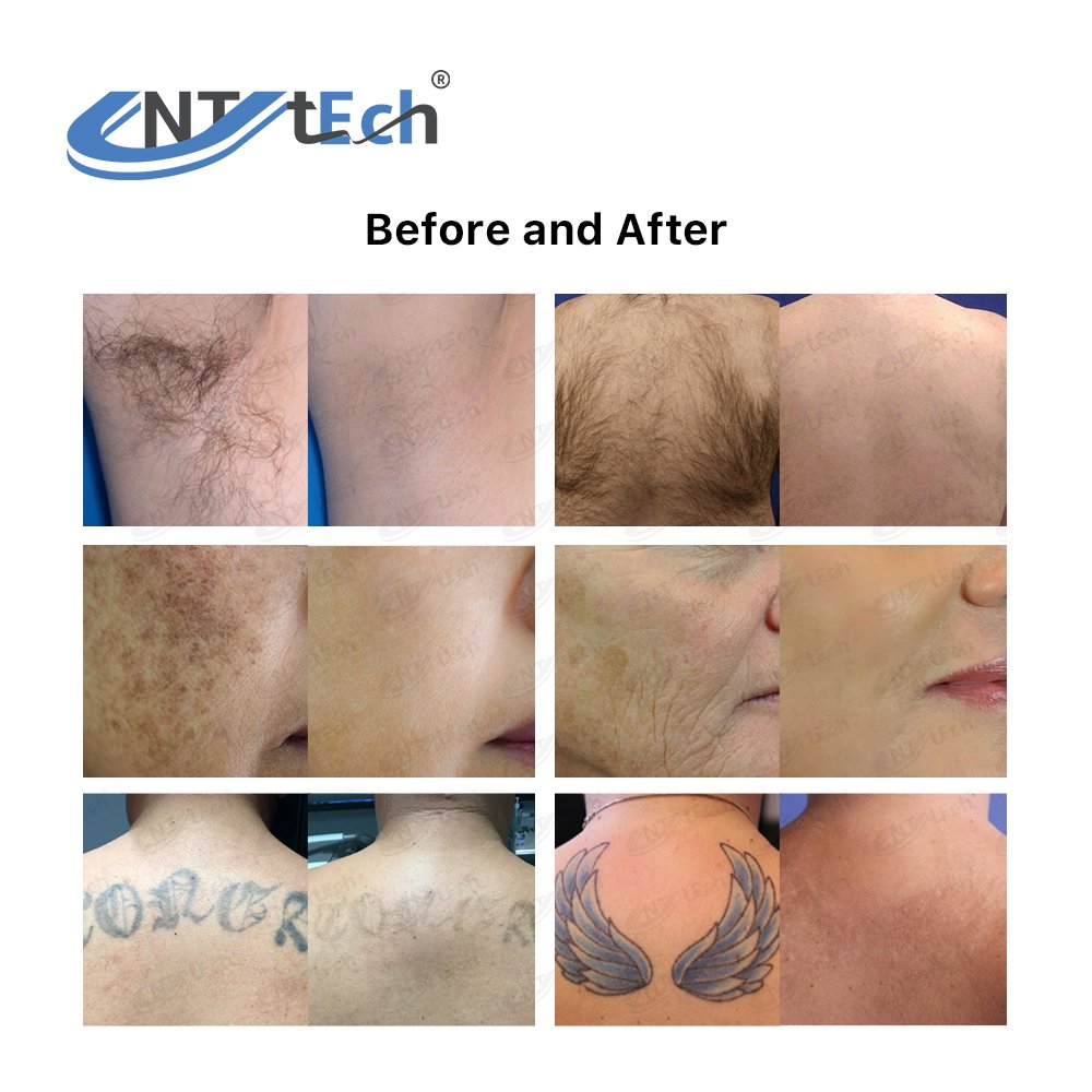 Beijing unt 2 handles 808 diode laser hair removal and laser tattoo removal machine machine