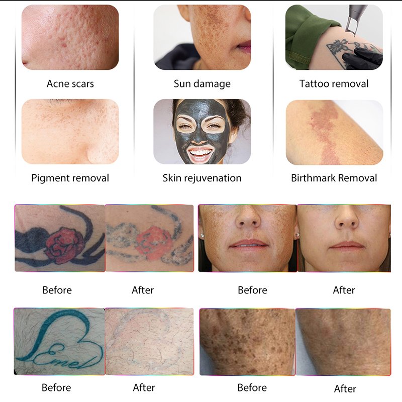 Factory Price Pico Laser Q Switch For Tattoo Removal Freckle Removal Spot Removal Picosecond Laser Carbon Peel Machine Price
