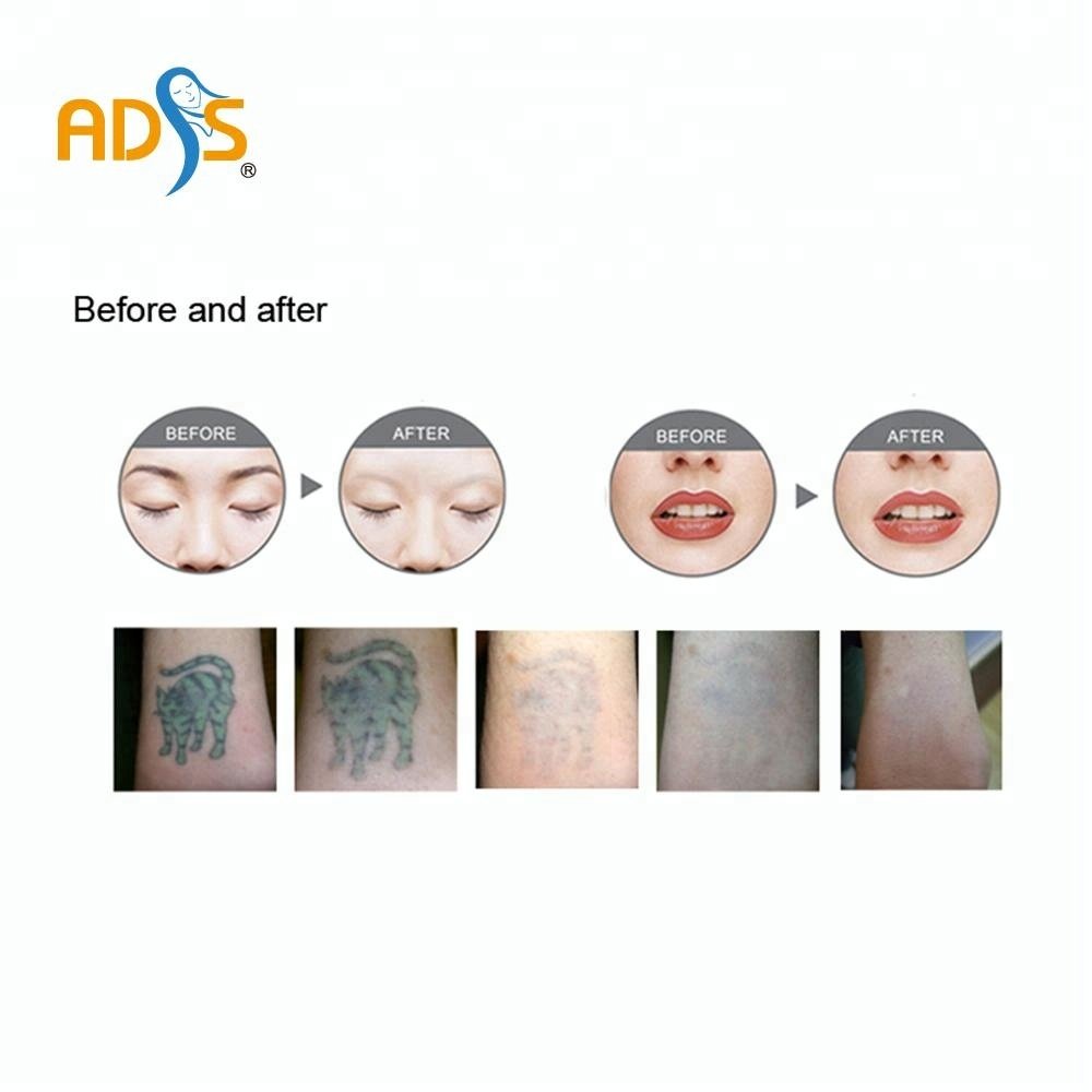 2023 hotest Double road Laser tattoo removal ----RY 580 Tattoo removal