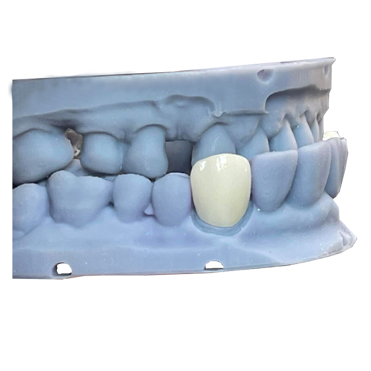 3d Printing Tooth Oral Cavity Dental Implant Rapid Prototype Model