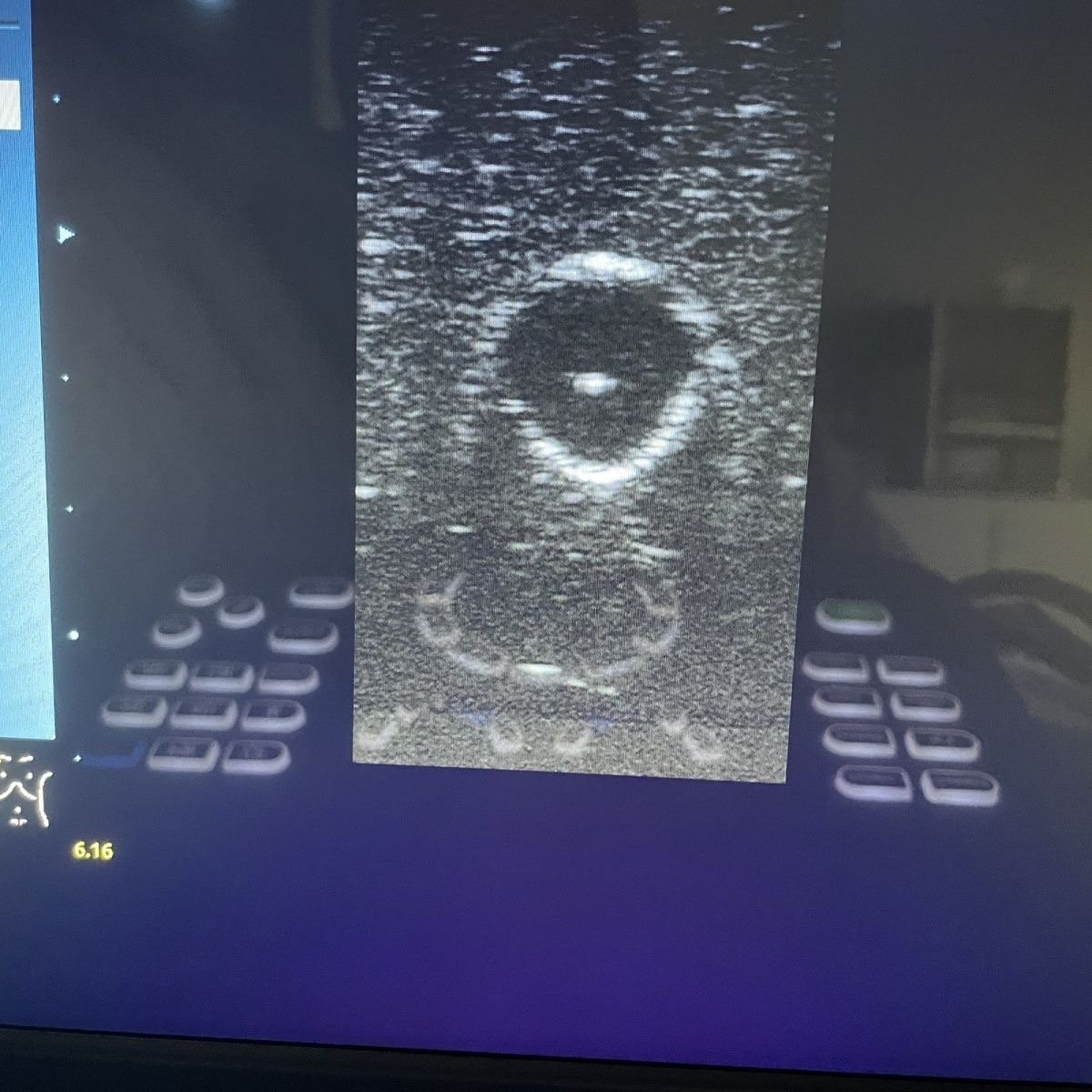 KyrenMed Ultrasound Guided Tumor Treatment Biopsy Model of Puncture Mass Needle Biopsy Model Ultrasound Puncture Training Model